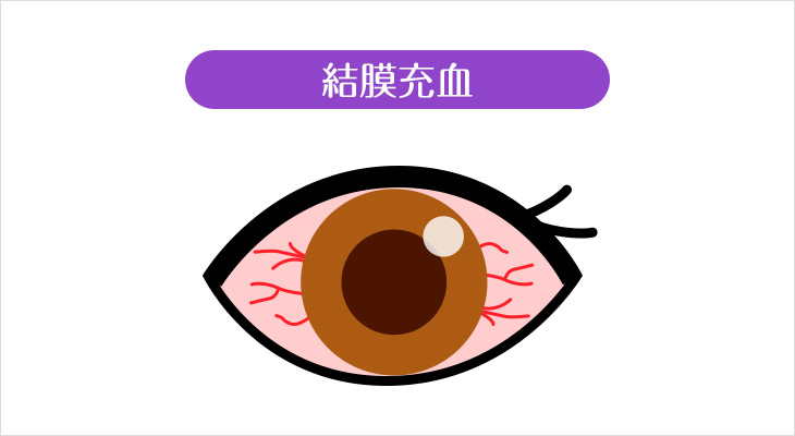 結膜充血説明図
